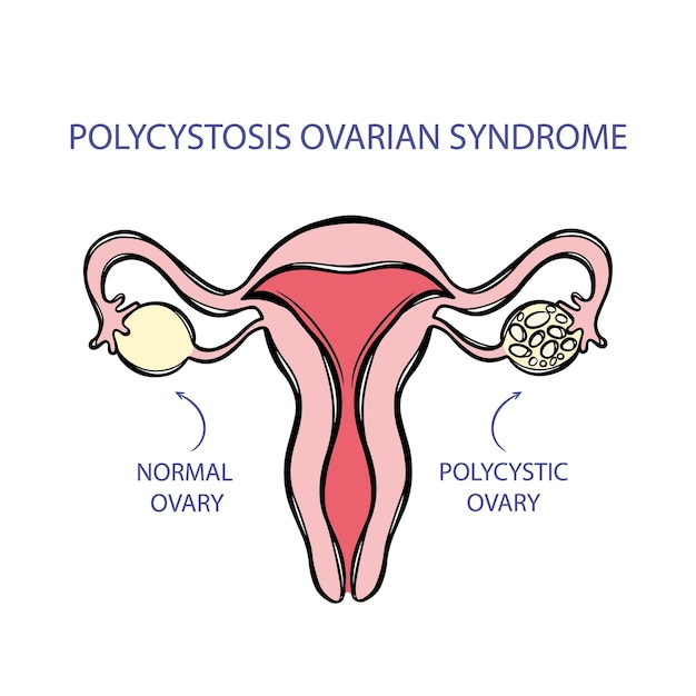 Detailed Illustration of Polycystic Ovarian Syndrome Anatomy | Jiffy ...