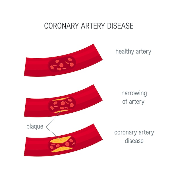 Detailed Illustration of Coronary Artery Disease Progression | Jiffy ...